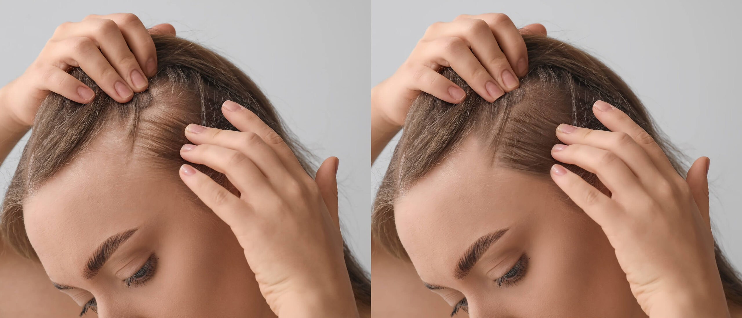 PRP Hair Treatment Before & After